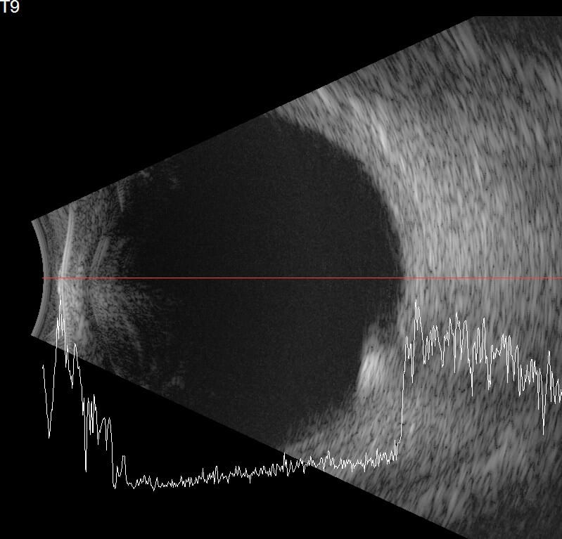 Left: Near infrared imaging shows the mulberry shaped lesion to have white “dots” interspersed throughout it. Right: On optical coherence tomography there are intralesional cavitations.