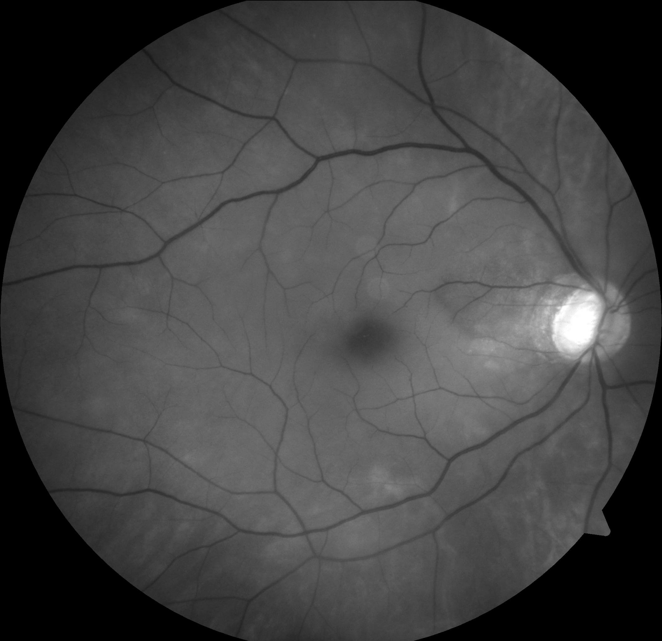 Red free imaging of the right fundus demonstrates arterial attenuation. No retinal emboli are seen.