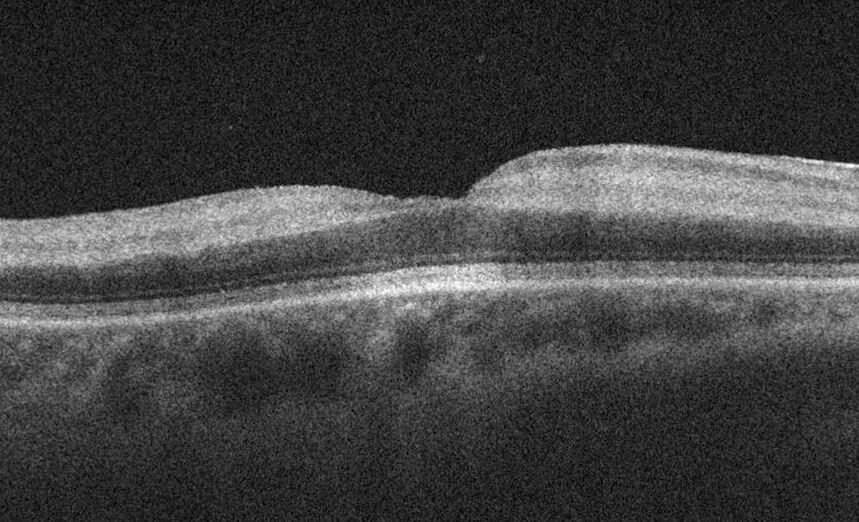 Right optical coherence tomography (horizontal raster scan) through the macula at presentation demonstrates increased reflectivity localized to the inner retina. A mild epiretinal membrane is present.