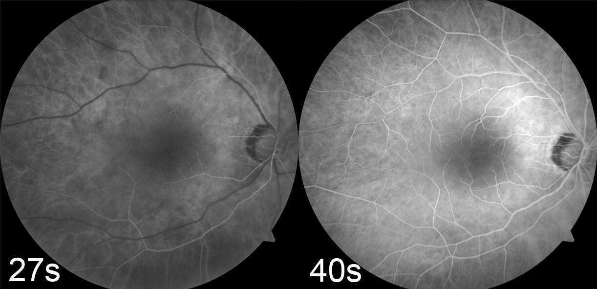 Left: Near infrared imaging shows the mulberry shaped lesion to have white “dots” interspersed throughout it. Right: On optical coherence tomography there are intralesional cavitations.