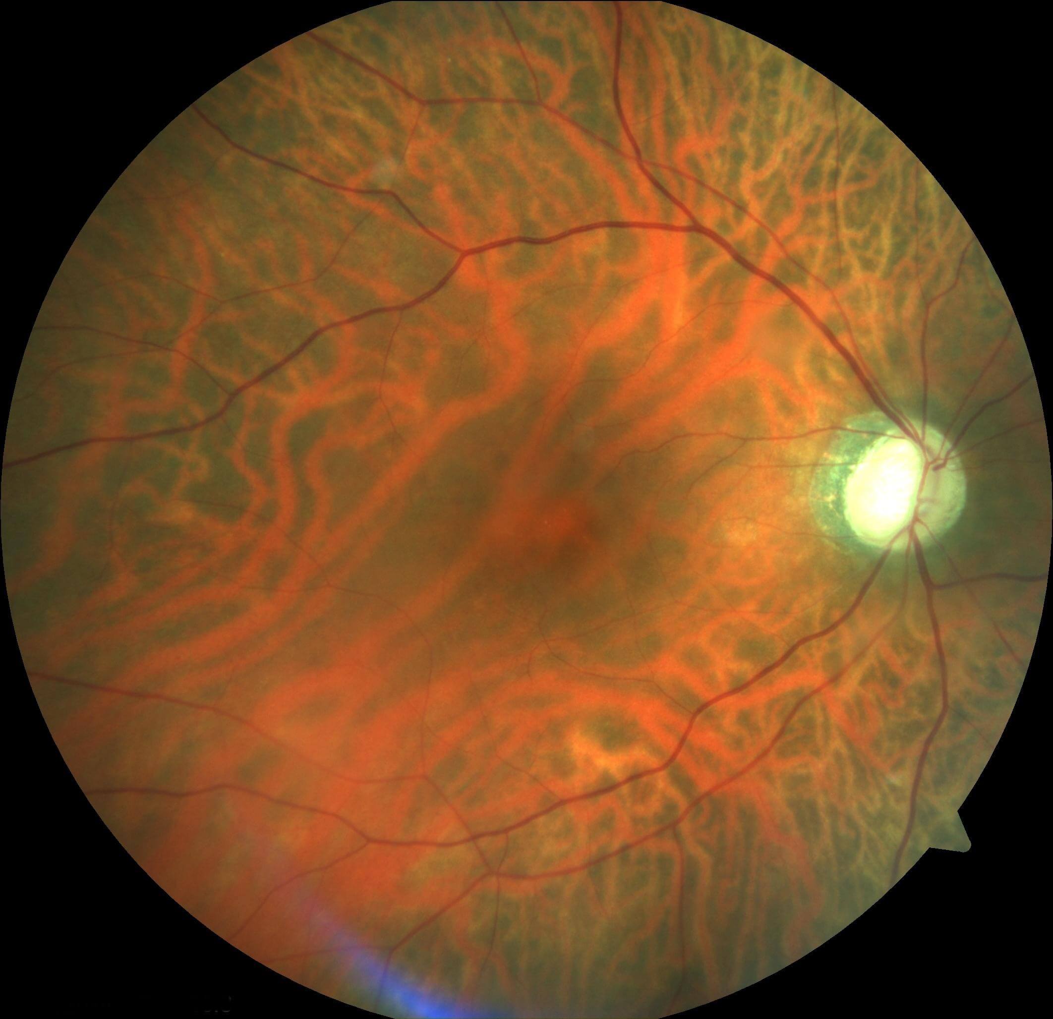 Right colour fundus photograph one month after presentation. There has been resolution of the cherry red spot. Some retinal oedema and whitening still persists. The retinal arterioles are attenuated and the disc is pale.