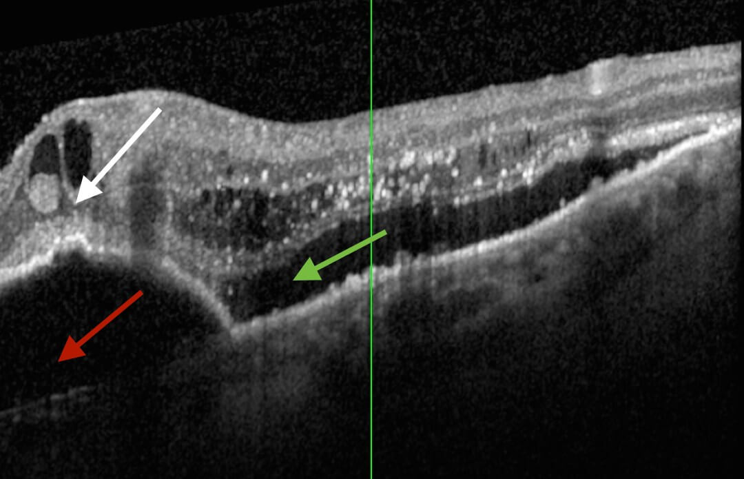Spectral-domain optical coherence tomography at presentation demonstrated an intraretinal hyper-reflective focus and intra-retinal cysts (white arrow) at the area corresponding to intraretinal haemorrhage, subretinal fluid (green arrow) and a large pigment epithelial detachment (red arrow).