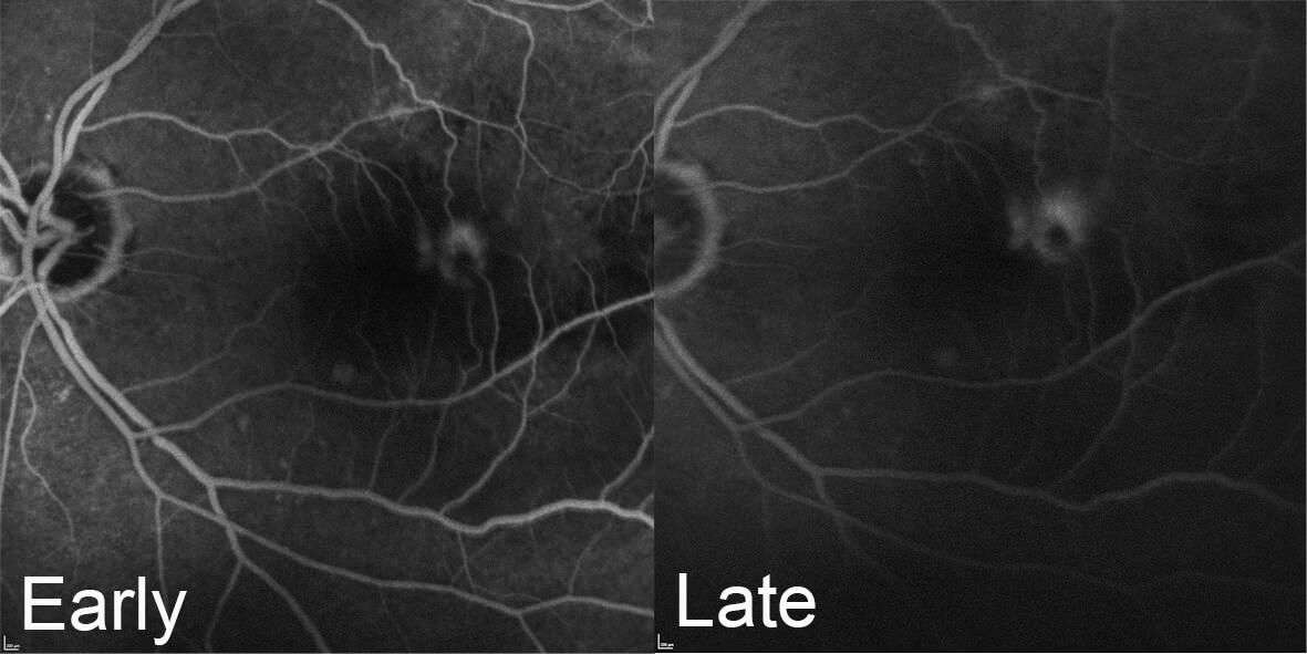  Fluorescein angiography demonstrated a focal point of intra-retinal hyperfluorescence with feeding arteriole and mild hyperfluorescent leakage.