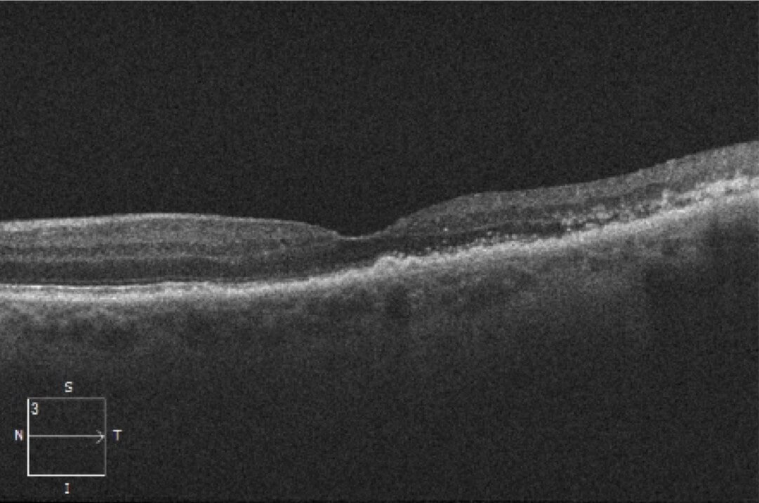 Right colour fundus photograph one month after presentation. There has been resolution of the cherry red spot. Some retinal oedema and whitening still persists. The retinal arterioles are attenuated and the disc is pale.