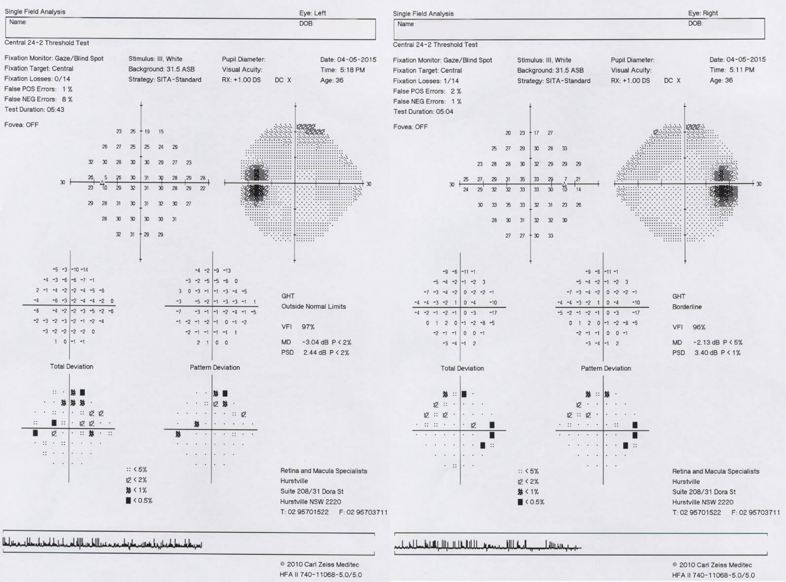  Humphrey Visual Field tests showing bilateral enlarged blind spots.