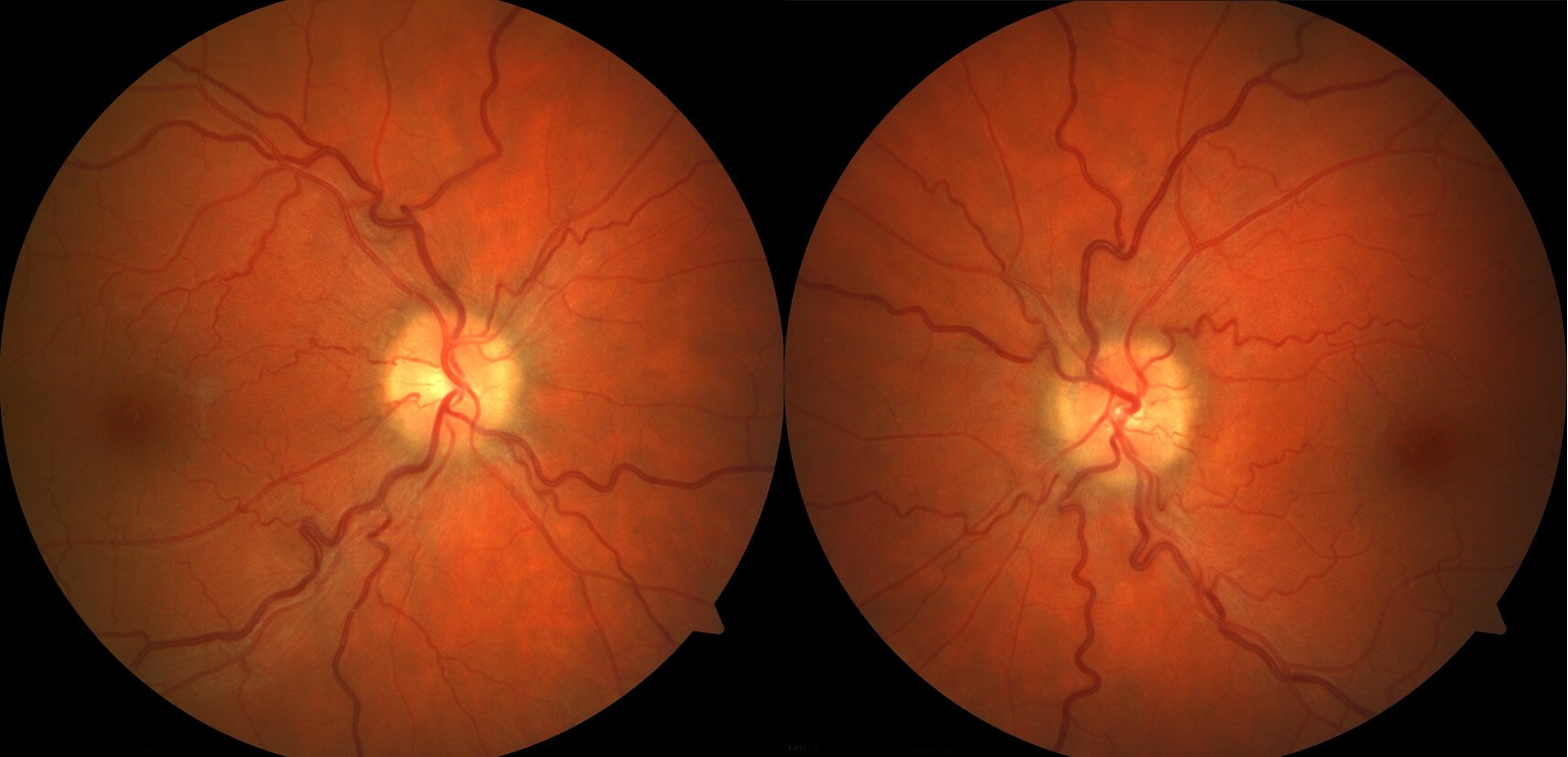 Resolution of the optic disc swelling, 3 months after commencement of acetazolamide (Diamox).