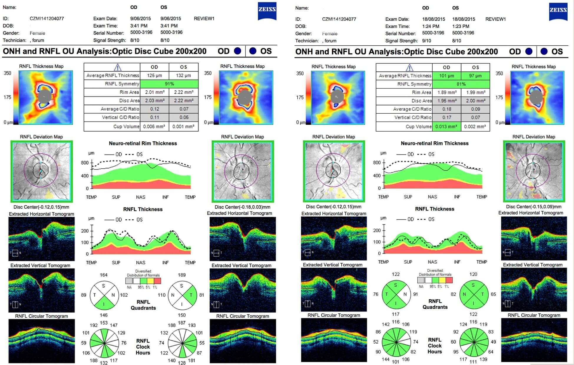 Over a 10-week period OCT of the retinal nerve fibre layer showed a reduction in thickness from 125μm to 101μm (right eye) and 132μm to 97μm (left eye).
