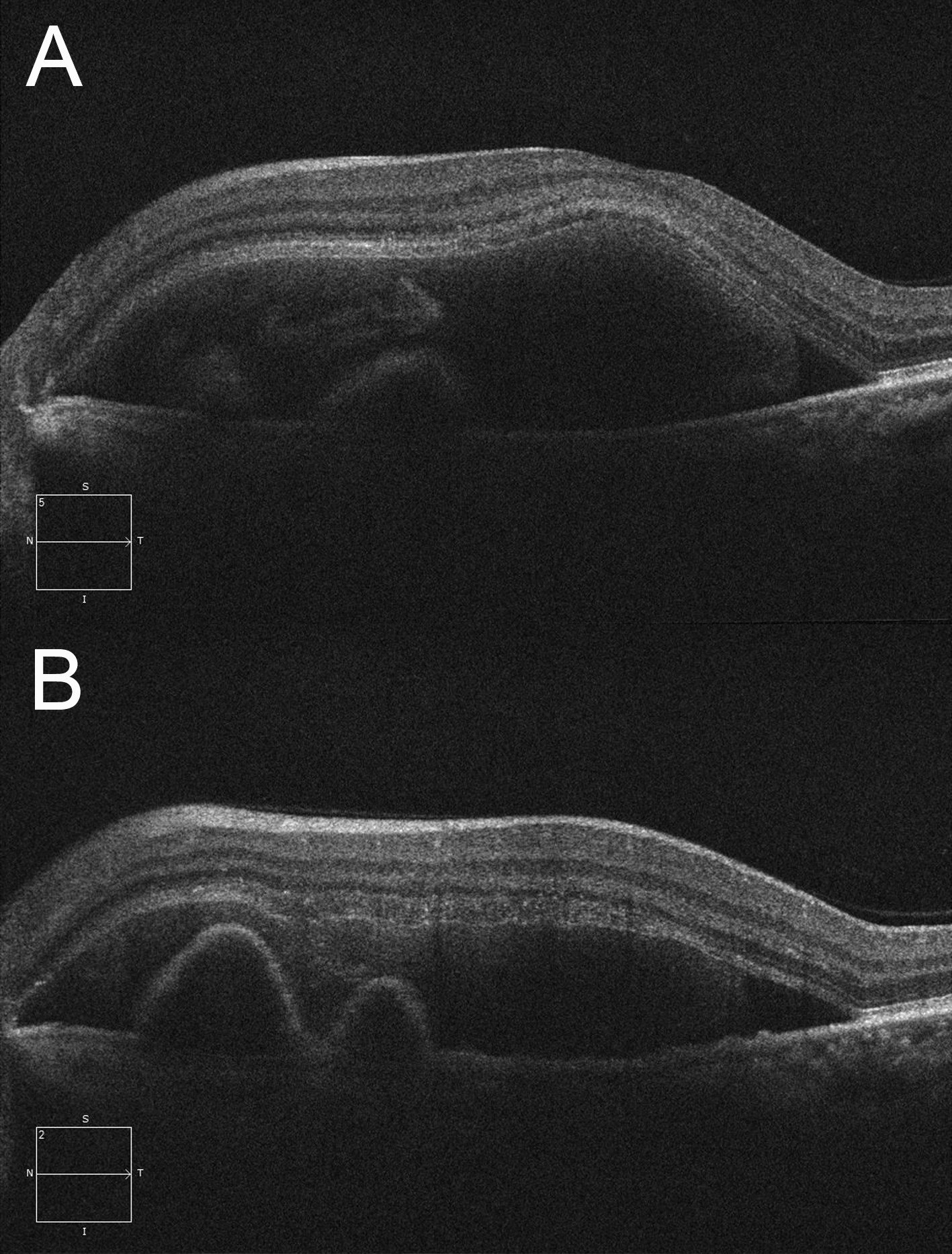 A) Left optical coherence tomography through the fovea demonstrating the subretinal location of the haemorrhage. B) Two sharply elevated pigment epithelial detachments are seen in a horizontal optical coherence raster scan taken superior to the fovea. These correspond with the polypoidal lesions noted clinically.