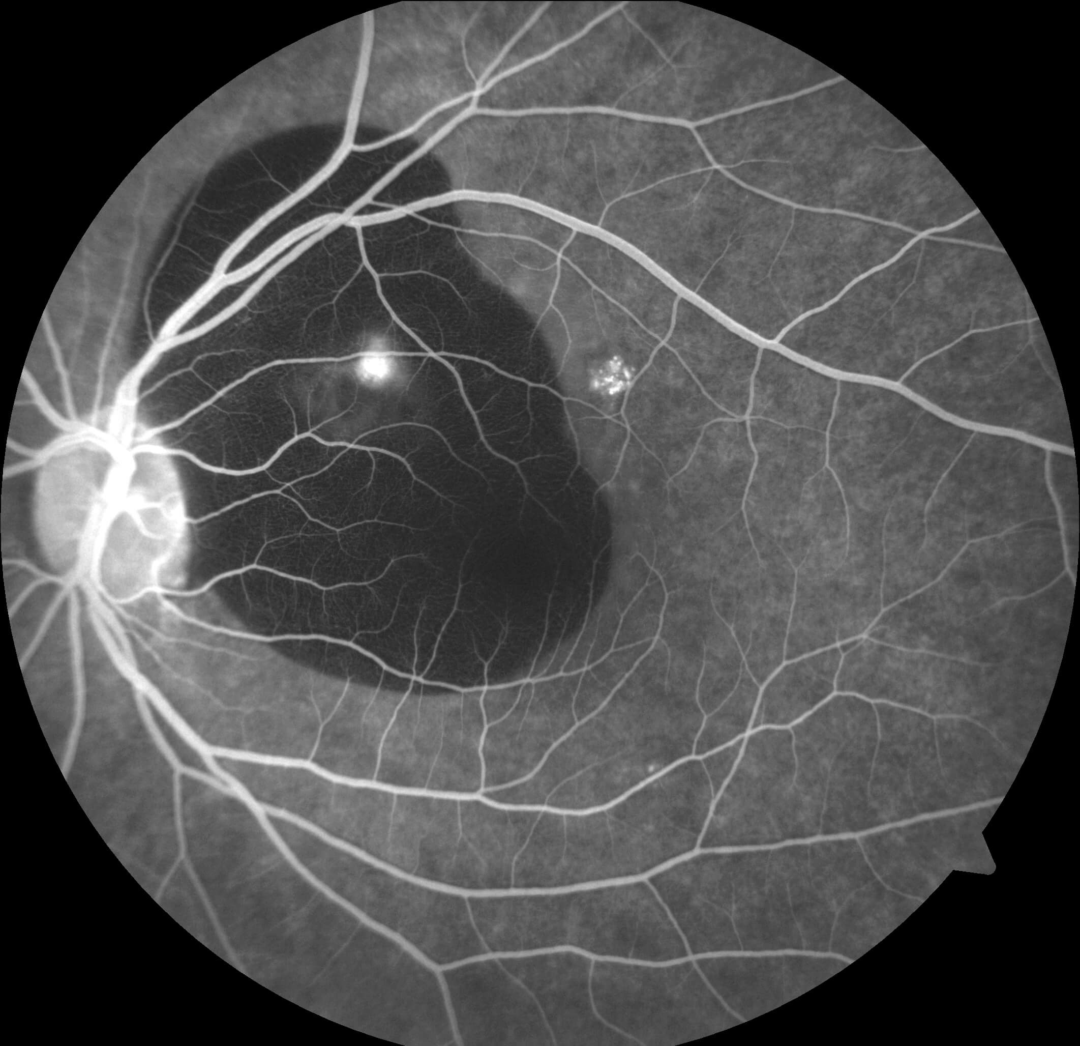  Left fundus fluorescein angiography shows blocked fluorescence from the haemorrhage and focal hyperfluorescent leakage superonasal to the fovea.