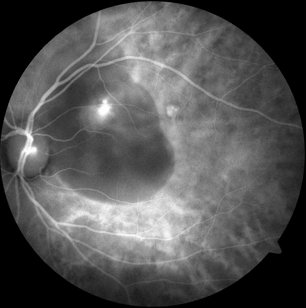 Left fundus fluorescein angiography shows blocked fluorescence from the haemorrhage and a focal polypoidal hyperfluorescent leakage superonasal to the fovea.