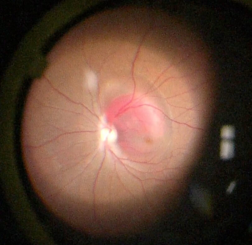 Intraoperative fundus photo after subretinal injection of tissue plasminogen activator (t-PA). Note the subretinal bleb extending from the superior injection site to the macula.