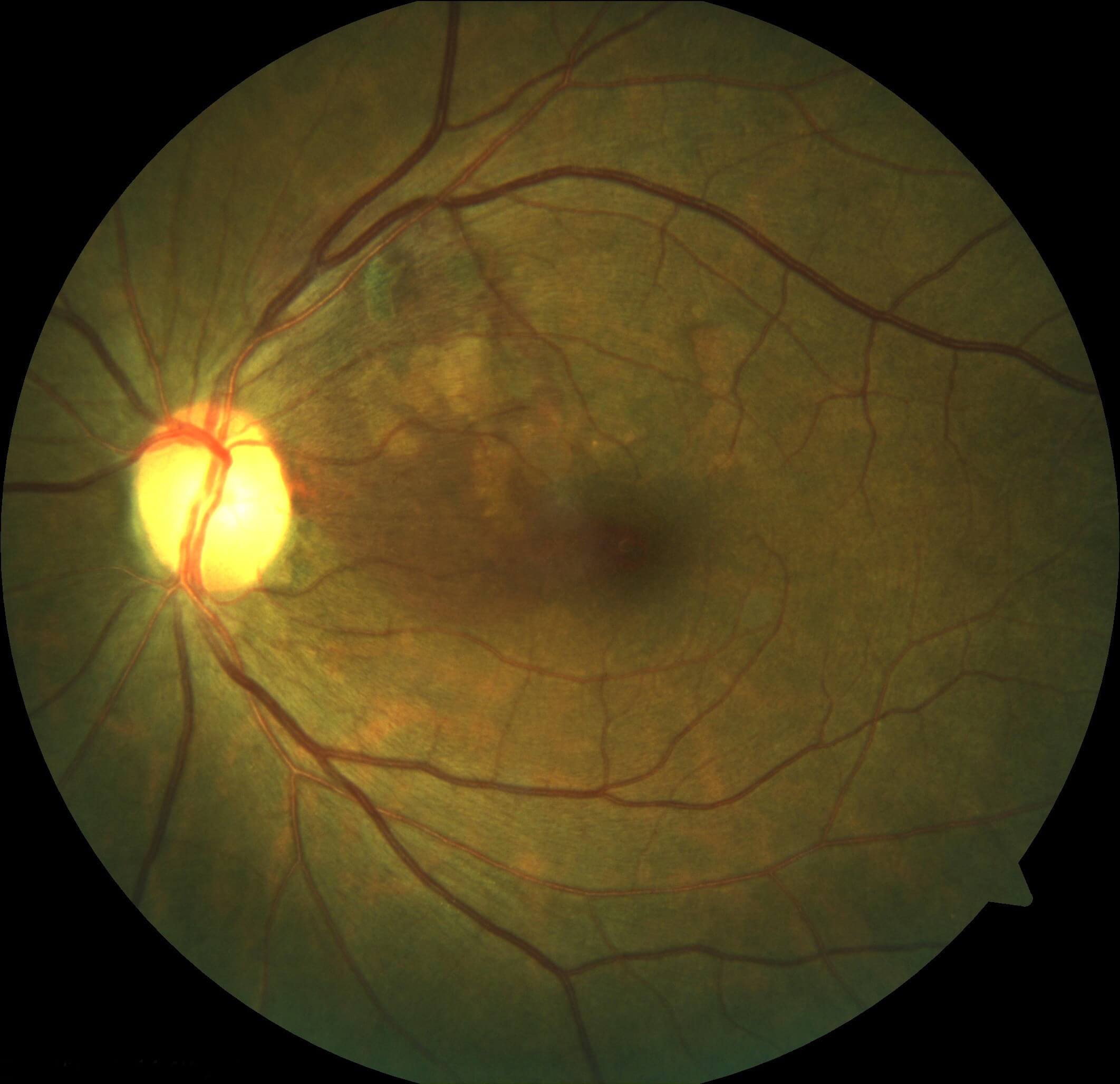 Postoperative left fundus photograph. There has been displacement the submacular haemorrhage with only mild residual haemorrhage remaining. The reddish-orange polypoidal lesions can still be seen superior to the fovea.