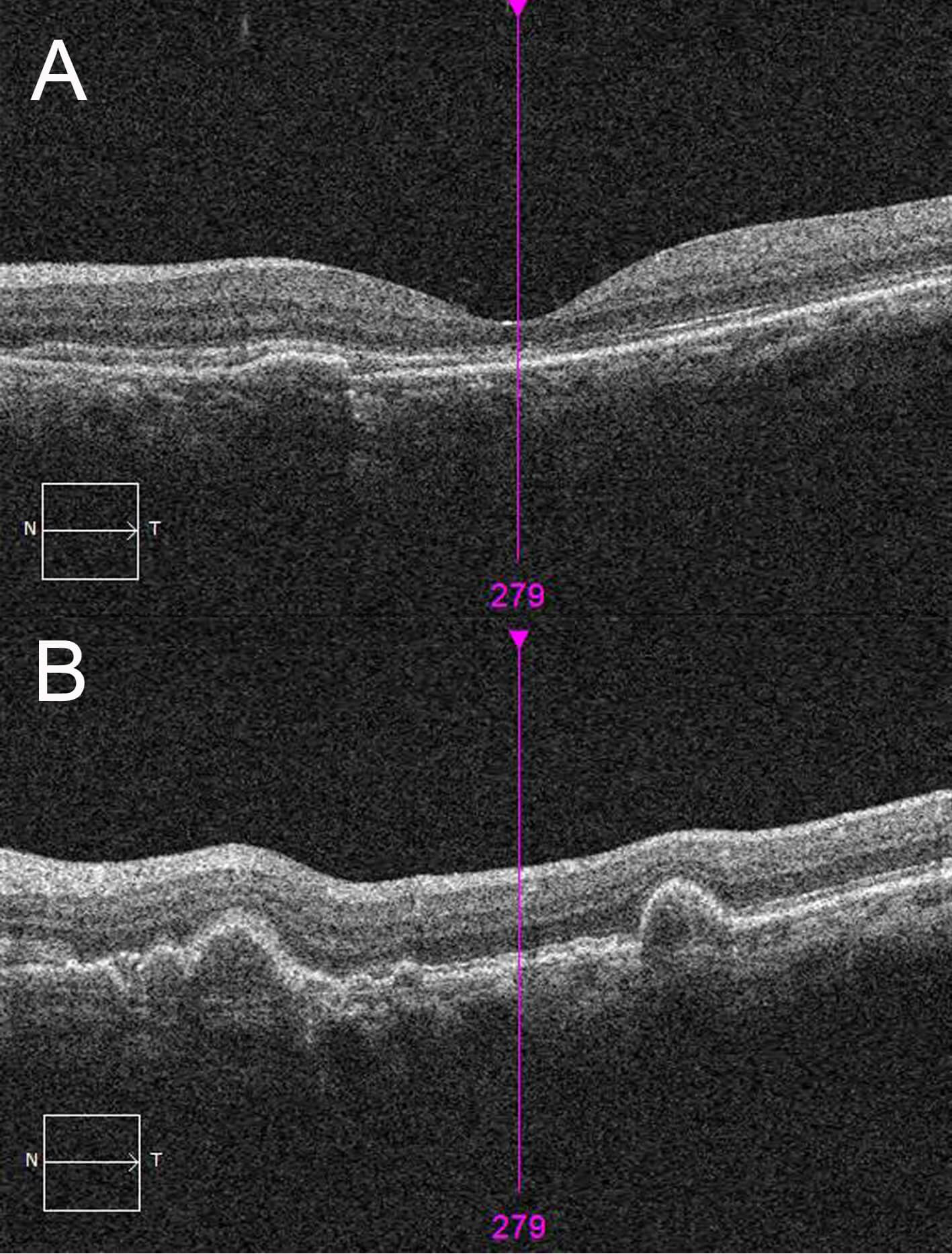 A) Postoperative optical coherence tomography scans taken horizontally through the level of fovea and B) superior to the fovea. Note the significant resolution of the submacular haemorrhage but persistence of the pigment epithelial detachments.