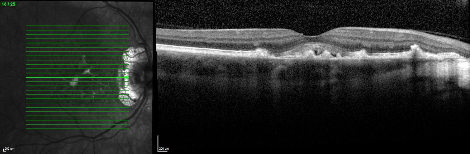 Optical coherence tomography localises the lesions to a sub-RPE location.
