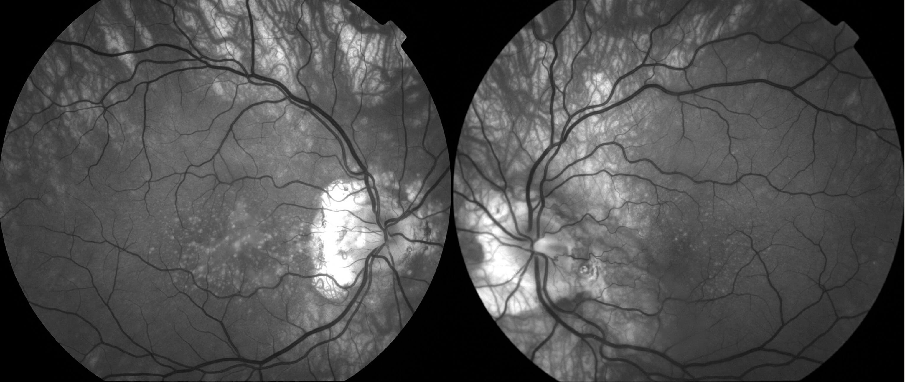 Red-free photography demonstrates the radial pattern of the drusen.