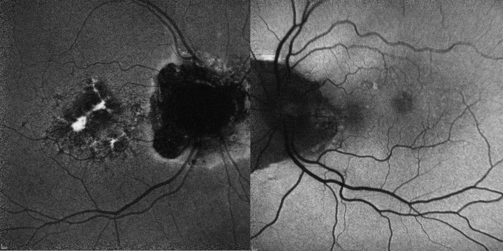 Autofluorescence is altered in the area of macula drusen and peripapillary regions of both eyes.