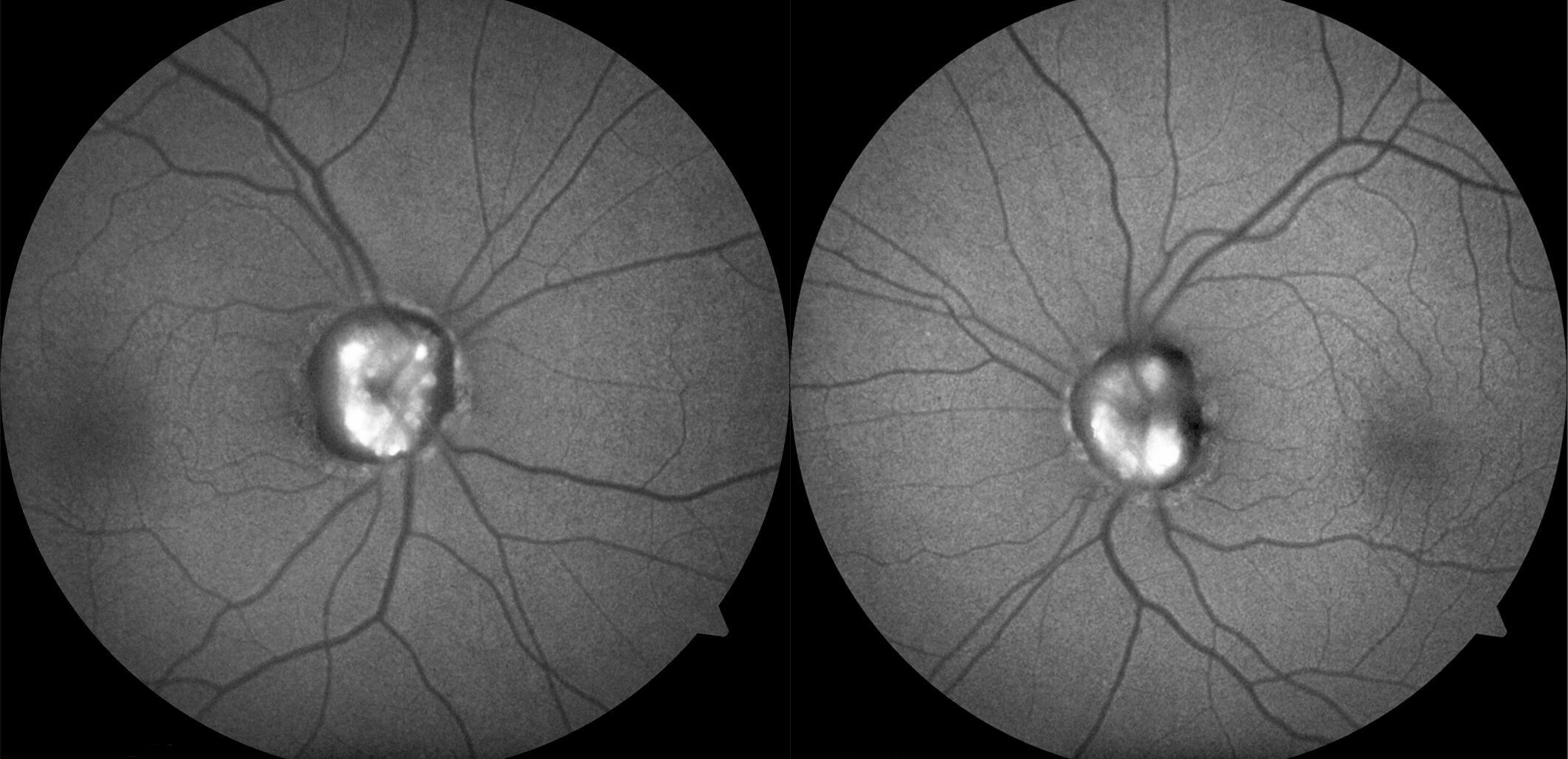 Fundus autofluorescence shows marked hyperautofluorescence at the optic discs.