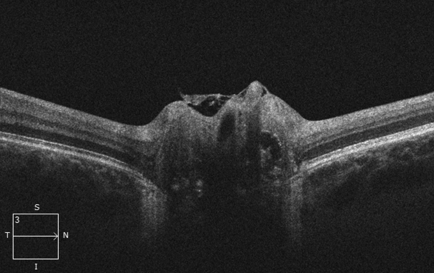 Optical coherence tomography of the right optic disc shows a granular appearance within the nerve.