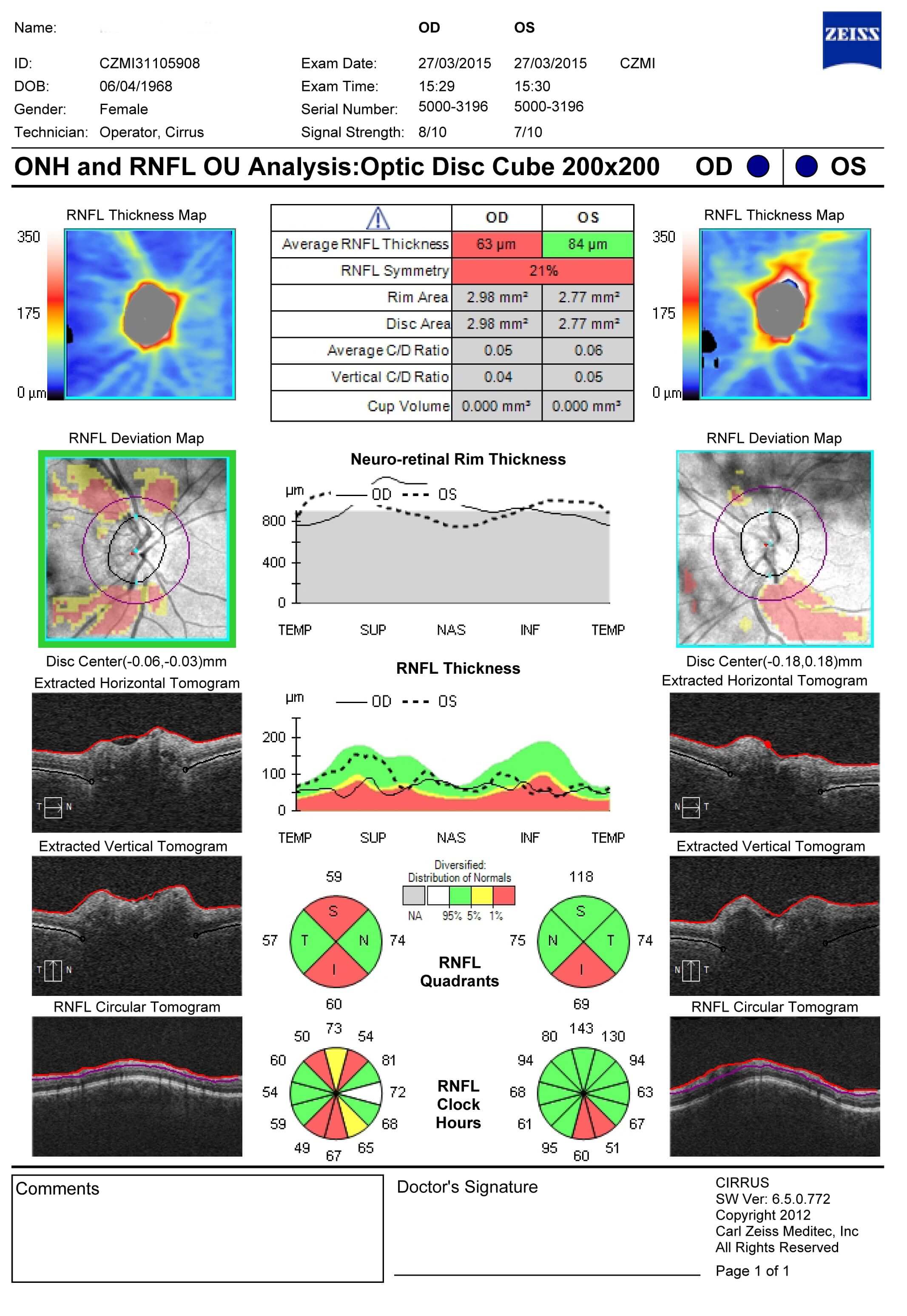 OCT RNFL shows thinning superior and inferiorly in the right eye and inferiorly in the left