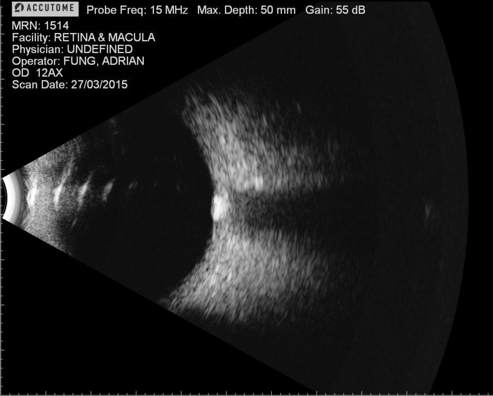 B-scan ultrasound shows a hyper-reflective mass at the optic nerve head.