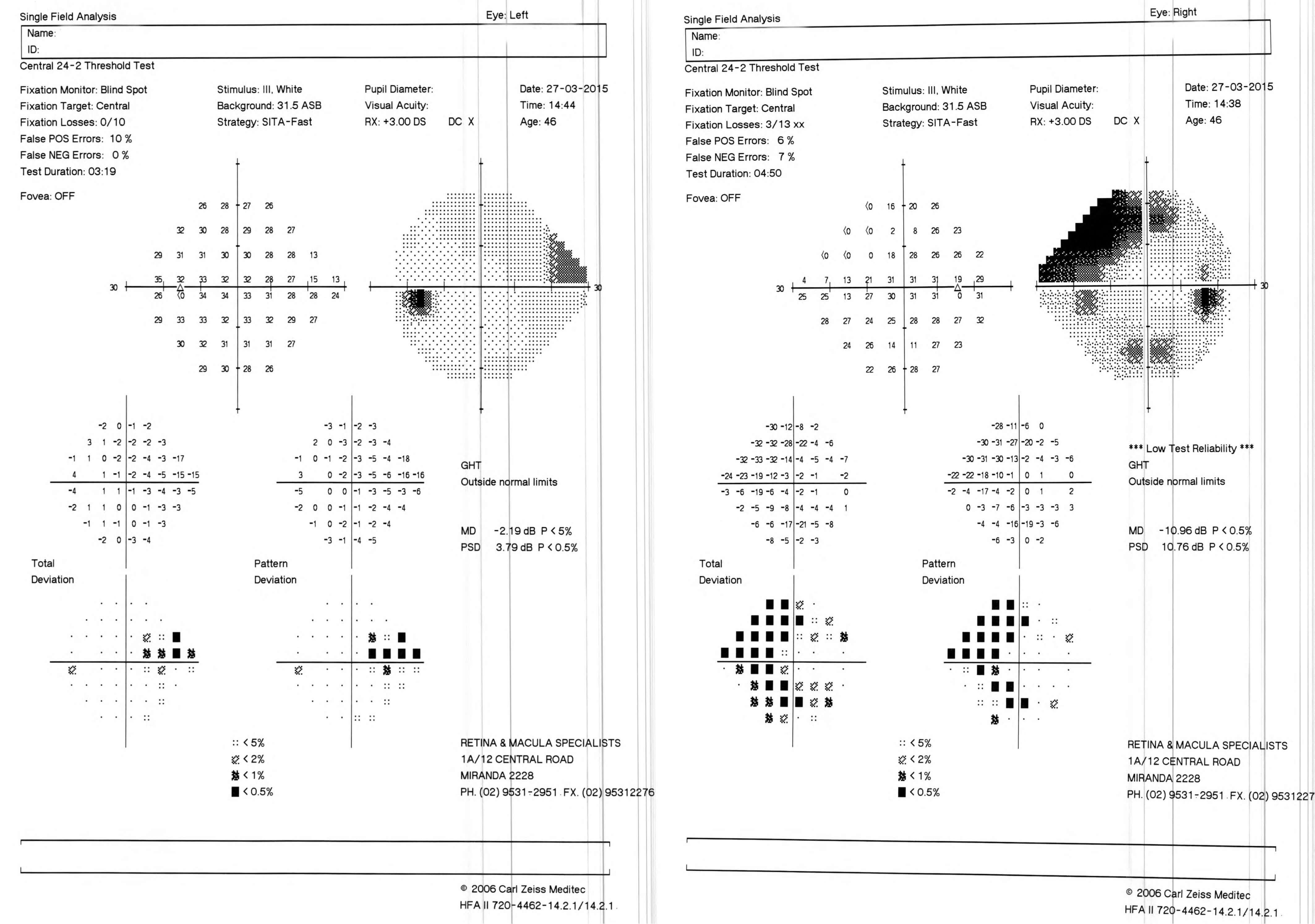 Humphrey visual field testing shows a superonasal scotoma in the right eye and nasal step in the left.