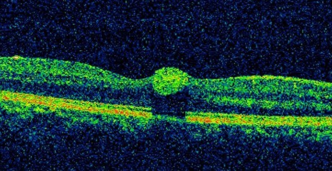 Right macular optical coherence tomography scan demonstrating the hyper-reflective haemorrhage located in the inner retina and underneath the internal limiting membrane (sub ILM).