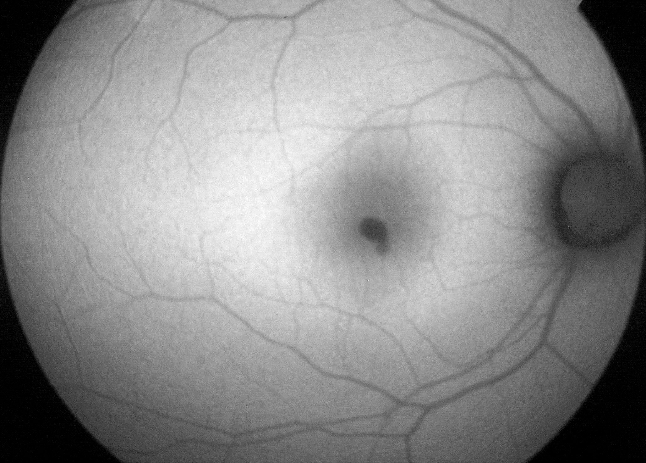 Right fundus autofluorescence imaging demonstrating hypoautofluorecence in the location of the haemorrhage, due to blocking of normal retinal pigment epithelial hyperautofluorescence.