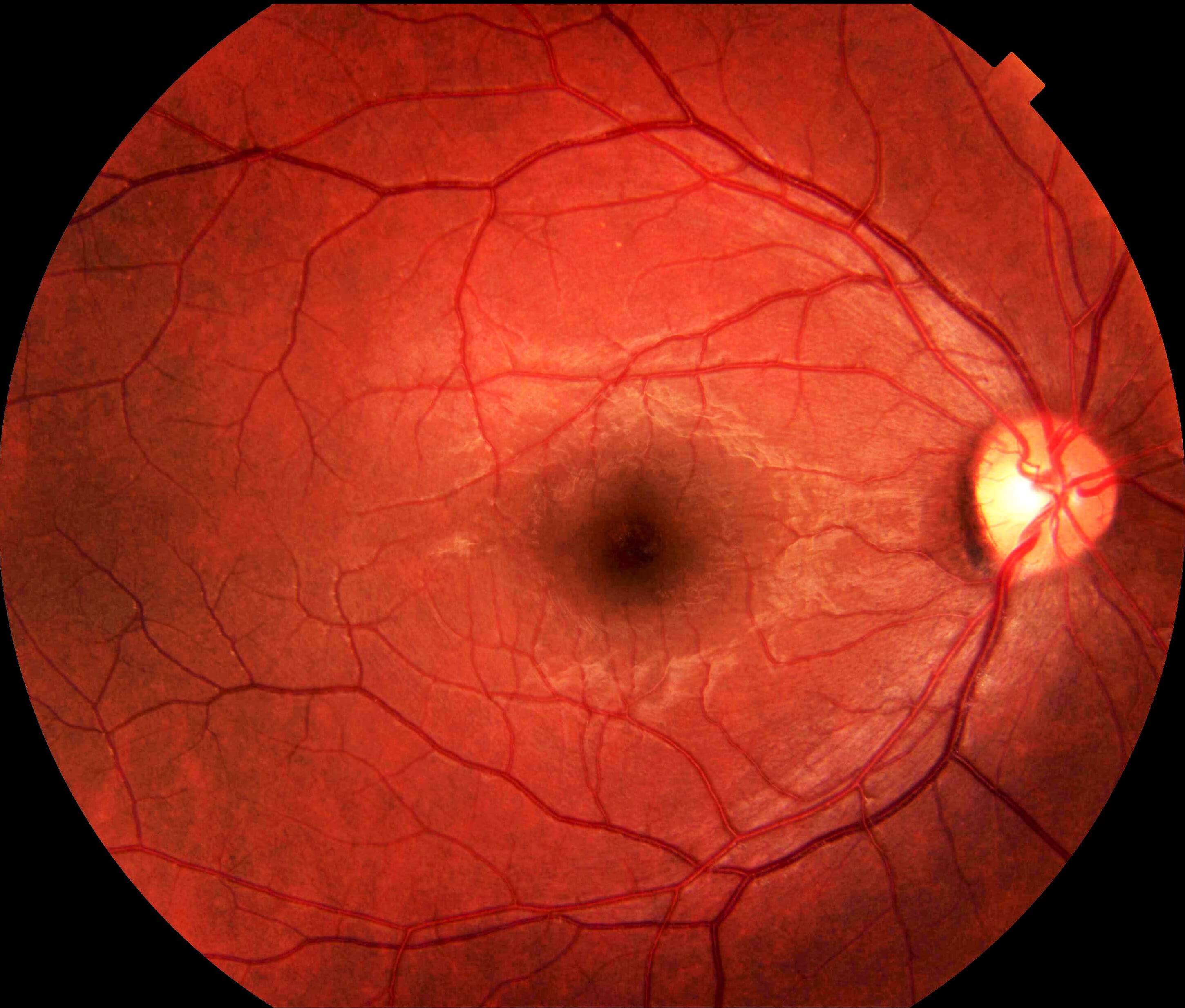Right fundus autofluorescence imaging demonstrating hypoautofluorecence in the location of the haemorrhage, due to blocking of normal retinal pigment epithelial hyperautofluorescence.