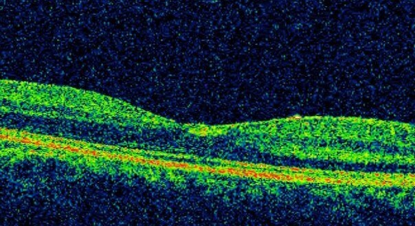 Right OCT scan four weeks after intital presentation shows only a small amount of residual inner retinal hyper-reflectivity.