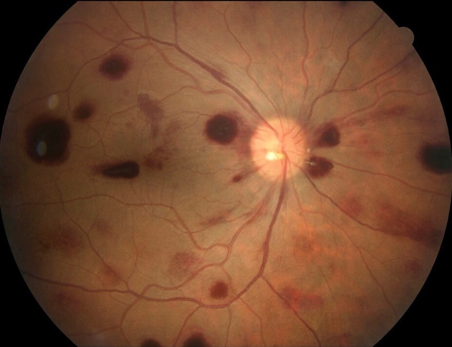 Right OCT scan four weeks after intital presentation shows only a small amount of residual inner retinal hyper-reflectivity.