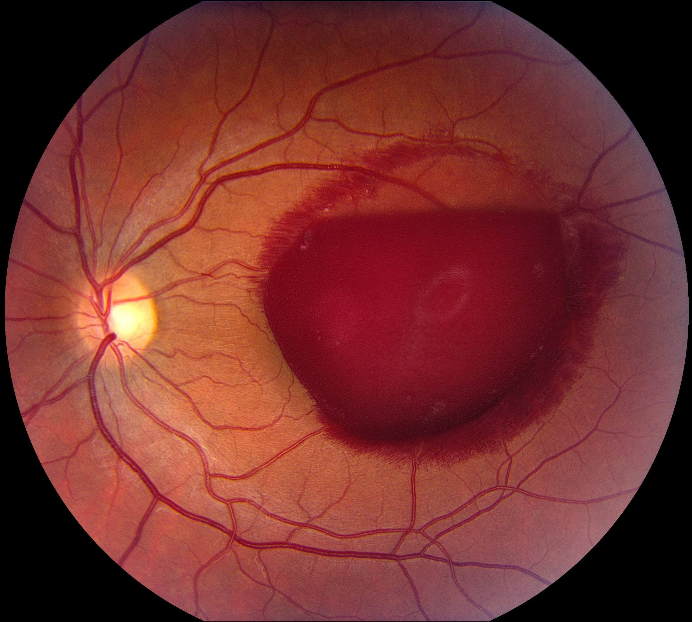 An extremely large left premacular haemorrhage due to a Valsalva manoeuver.