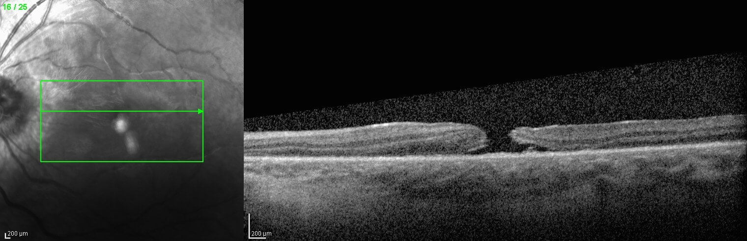 Optical coherence tomography through the left macula at presentation. A full thickness macular hole is present.