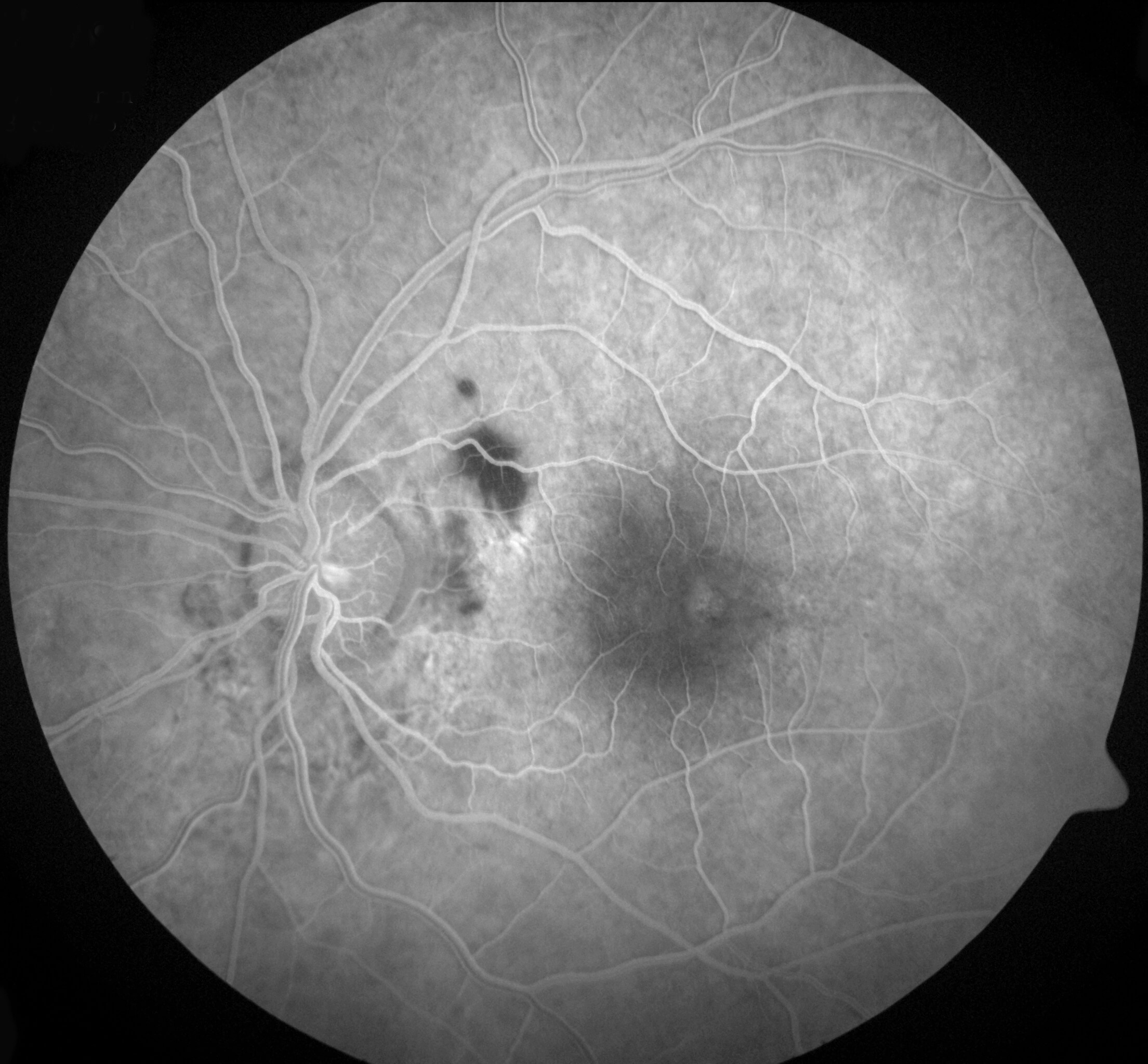 Fluorescein angiography demonstrated a small area of mild hyperfluorescence in the temporal perifoveal area that did not increase in intensity or size over time. Peripapillary areas of hypofluorescence correlate to deep retinal haemorrhages with no evidence of choroidal rupture.