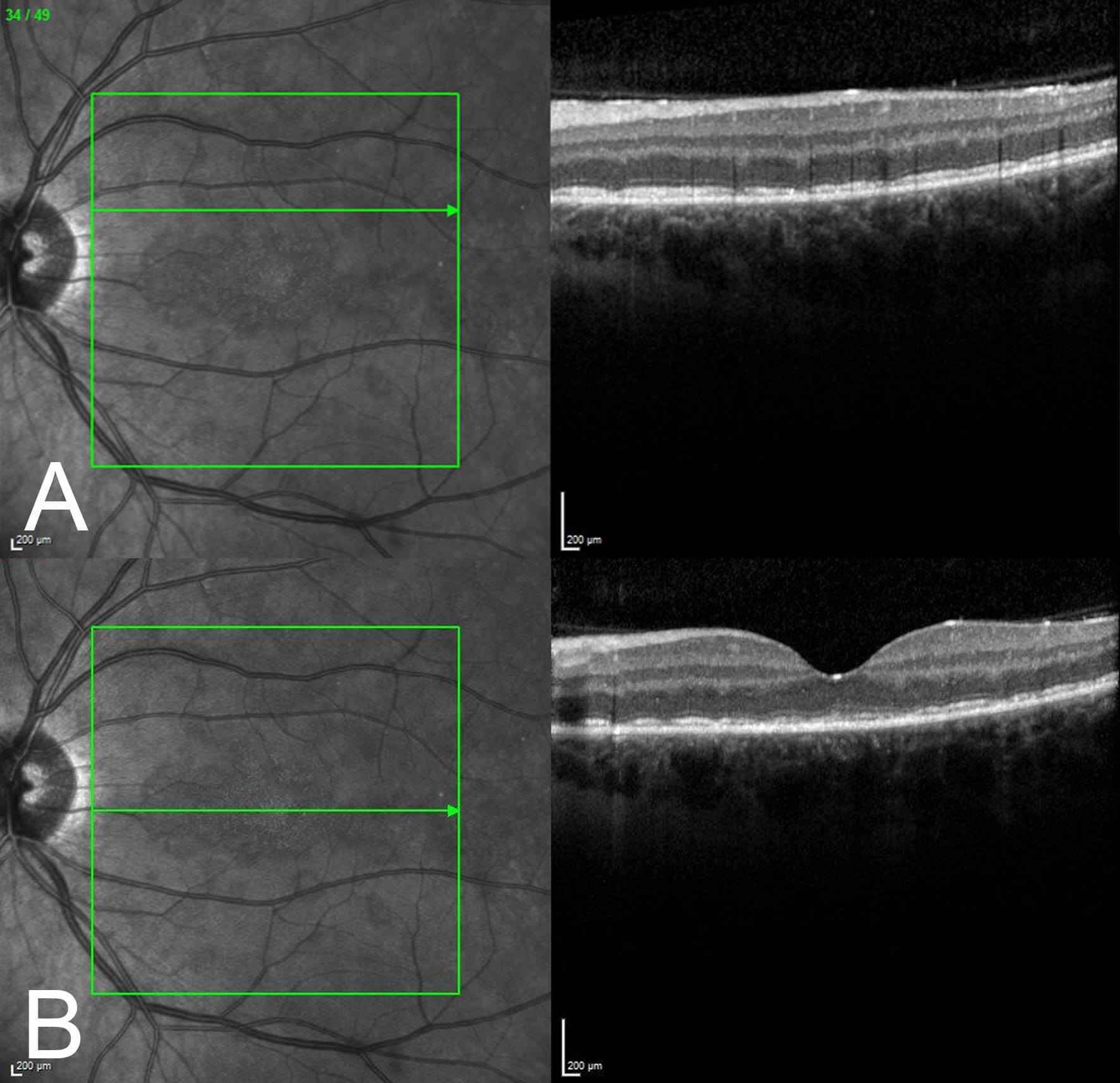 Optical coherence tomography through the left macula at presentation. A full thickness macular hole is present.