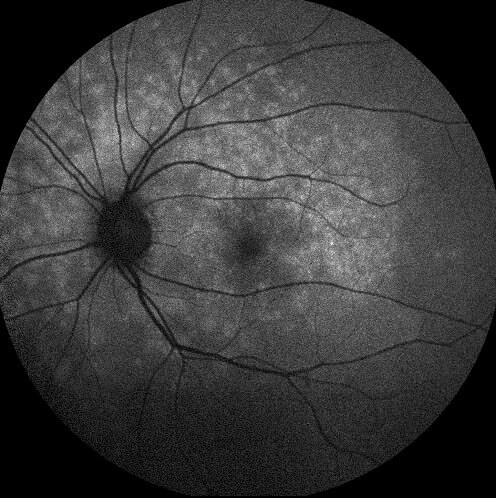 Blue light autofluorescence of the left eye shows multiple hyperfluorescent lesions in the posterior pole, especially in the paramacular region, extending nasal to the optic disc.