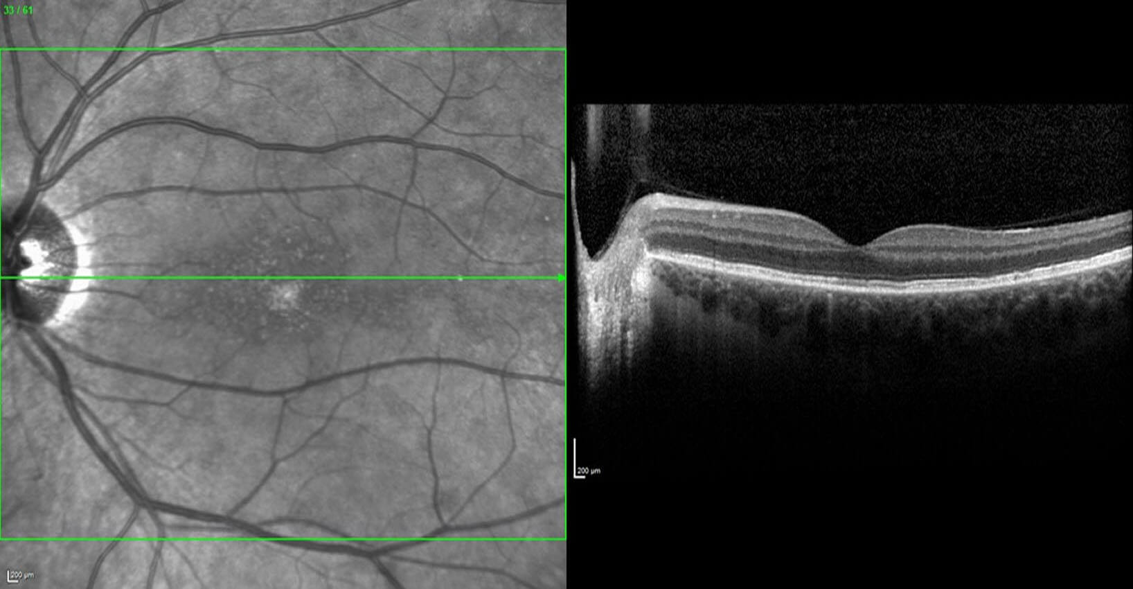 Optical coherence tomography at 3-weeks shows the photoreceptor layer returning to normal. Note the foveal granularity in the near-infrared image to the left.