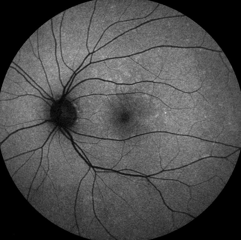 Fundus autofluorescence at 3-weeks shows a significant reduction in hyperautofluorescent lesions at the left macula.
