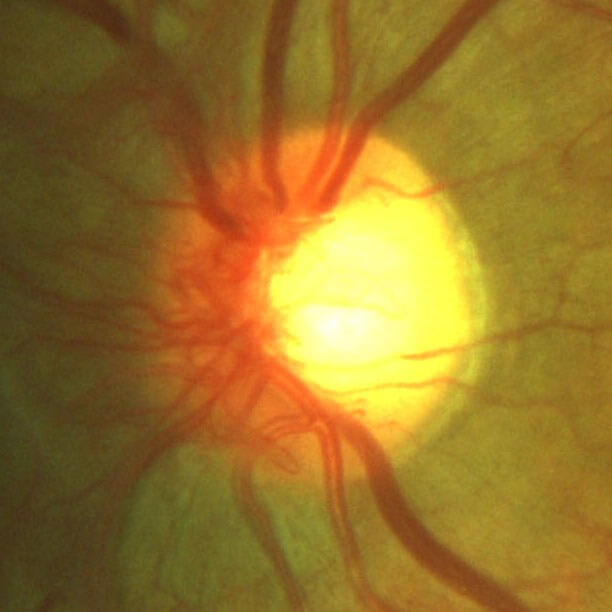 Magnified view of the left optic disc showing neovascularization (“new vessels”).