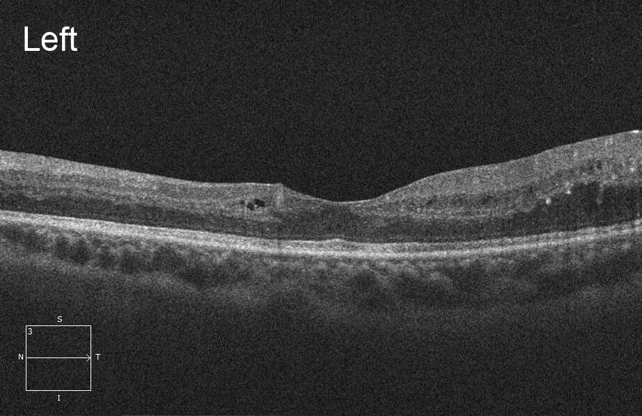 Optical coherence tomography of the left macula demonstrates mild intraretinal fluid spaces temporally and hyperreflective deposits consistent with hard exudates.