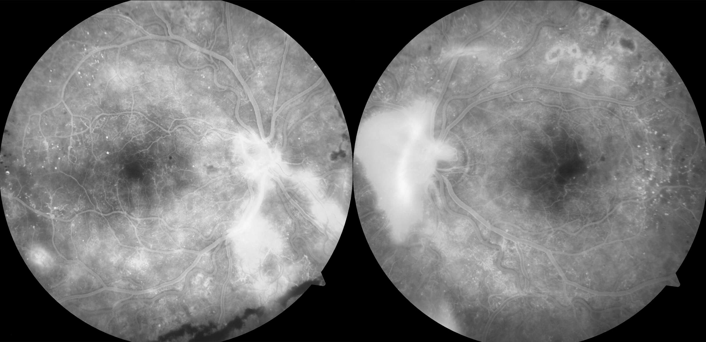 Fundus fluorescein angiography shows hyperfluorescent leakage from new vessels at both optic discs and along the right inferotemporal vascular arcade. Hyperfluorescent microaneurysms are most prominent temporally where there is capillary dropout. The foveal avascular zones of both eyes are irregular. Blocked fluorescence from pre-retinal hemorrhage is seen inferiorly in the right eye. Panretinal photocoagulation laser marks are seen superotemporally in the left eye.