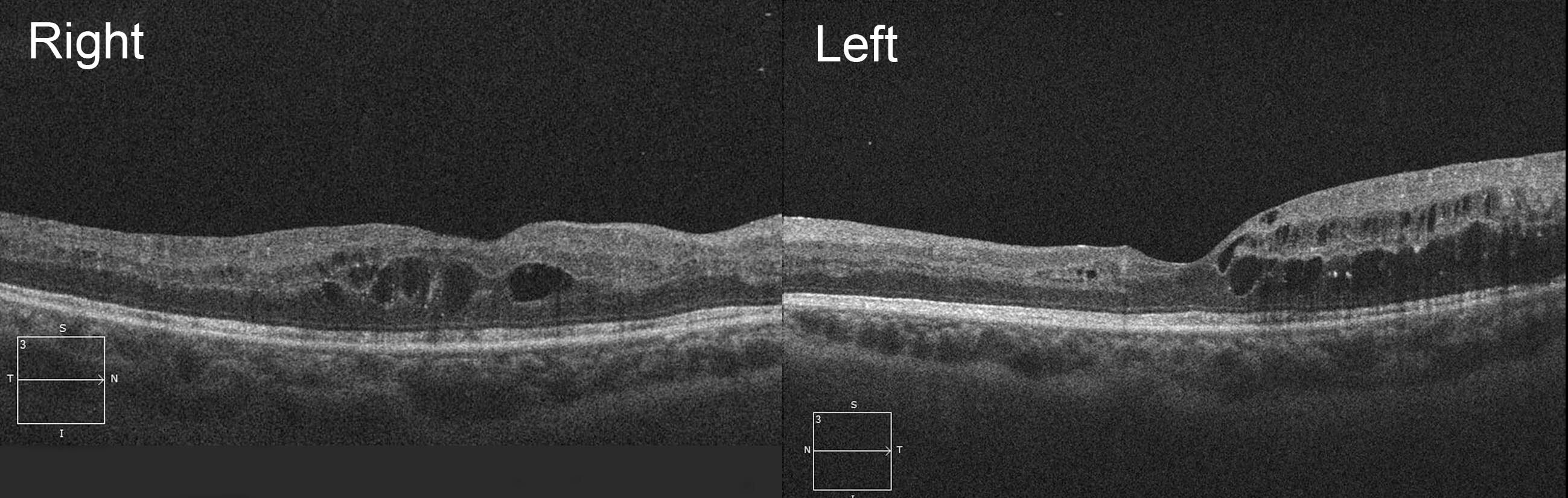 Optical coherence tomography scans show cystic oedema at the right fovea and temporal to the left fovea.