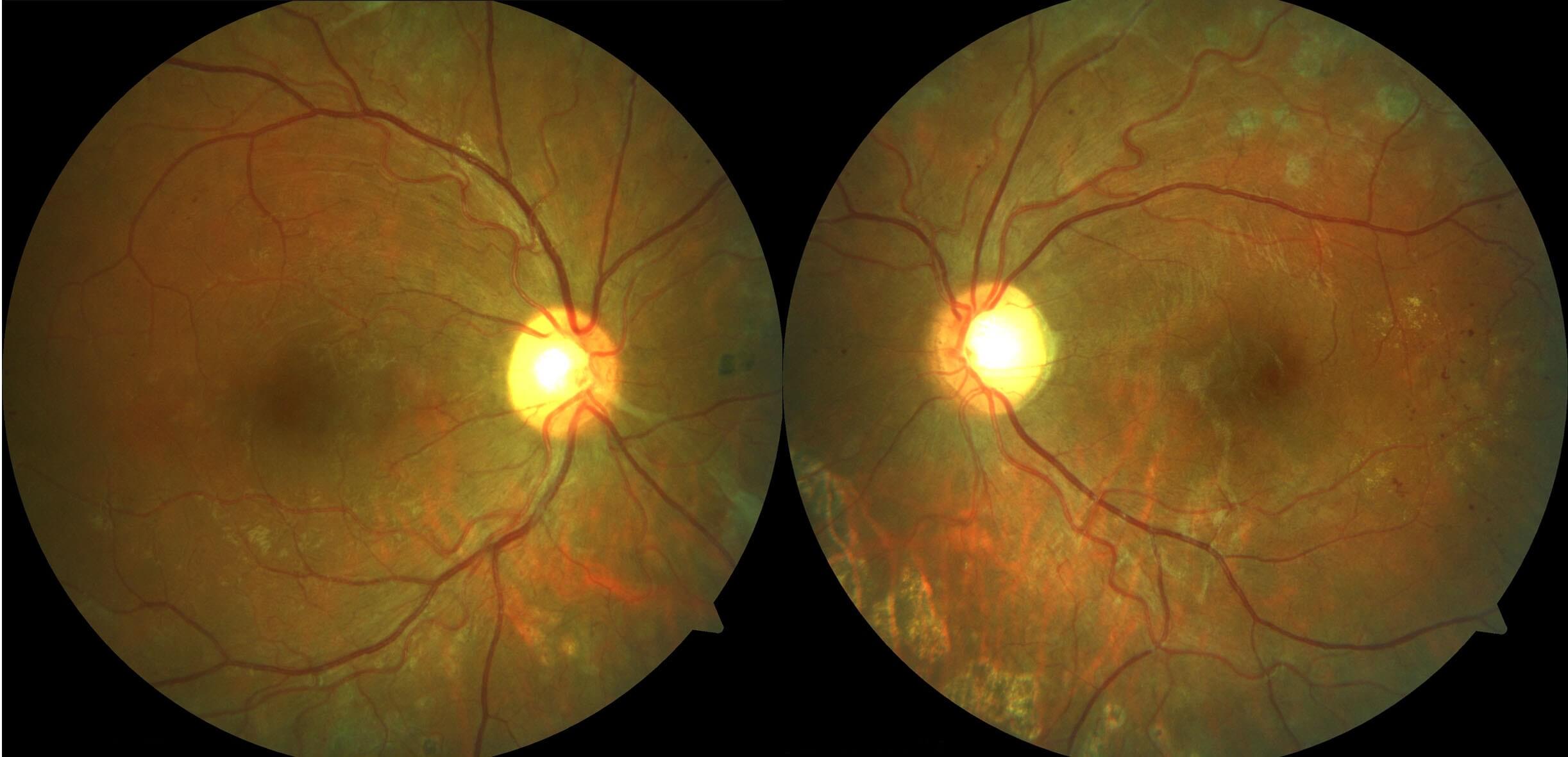 Colour fundus photographs demonstrating regression of the new vessels following peripheral panretinal photocoagulation. Note the peripheral laser scars.
