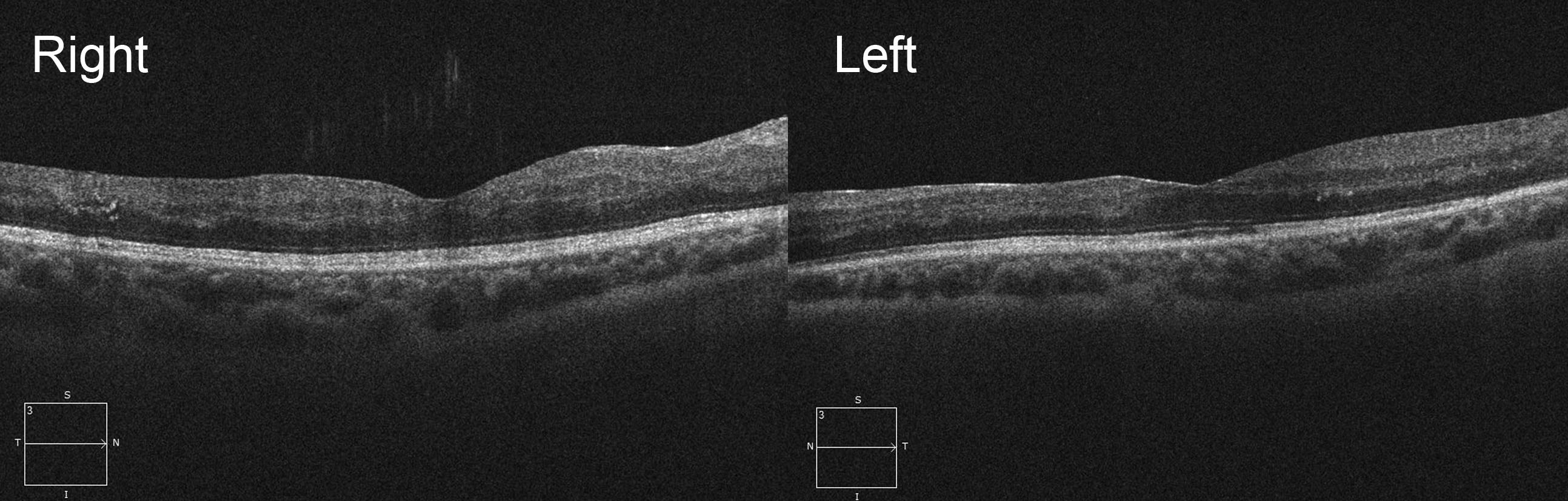 Optical coherence tomography scans showing resolution of the macular oedema following right intravitreal bevacizumab (Avastin®) injection and left focal macular laser.