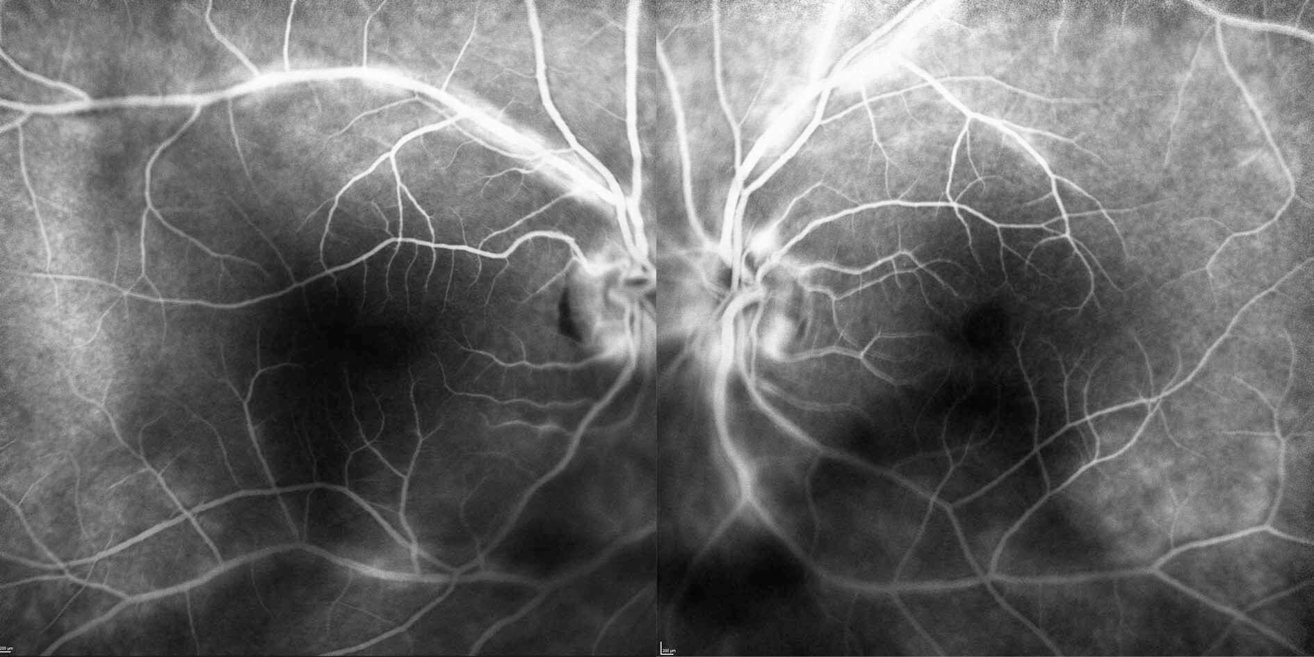 Fluorescein angiography demonstrates bilateral vasculitis (hyperfluorescent leakage along the retinal vessels) and disc leak.