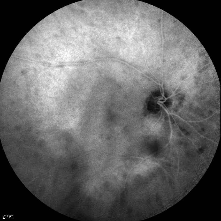 Indocyanine green angiography of the right eye demonstrates multiple hypofluorescent choroid lesions in a “birdshot” distribution in the posterior pole.