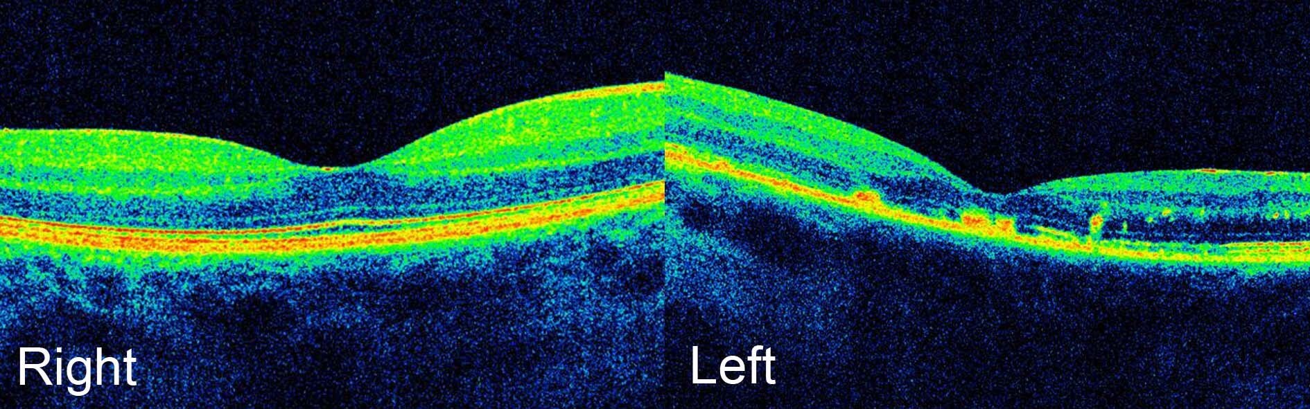 Optical coherence tomography images demonstrates hyper-reflective deposits in the left eye at the level of the retinal pigment epithelium and photoreceptors. There is no macular oedema.