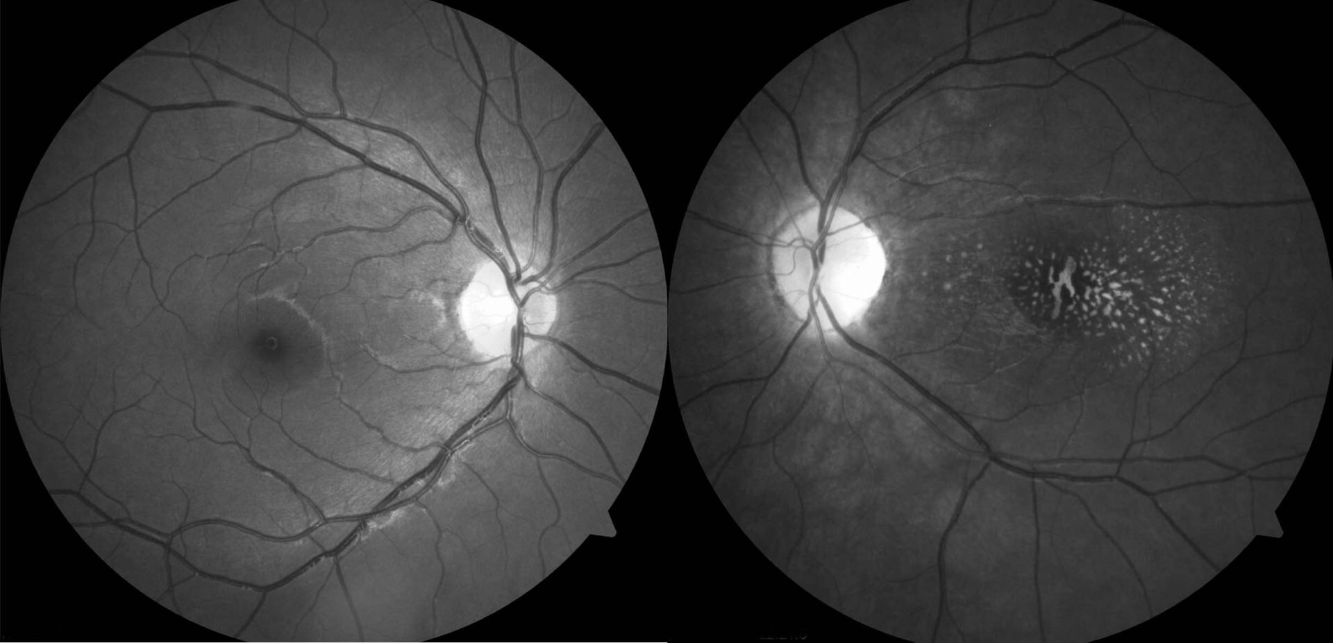 Indocyanine green angiography of the right eye demonstrates multiple hypofluorescent choroid lesions in a “birdshot” distribution in the posterior pole.