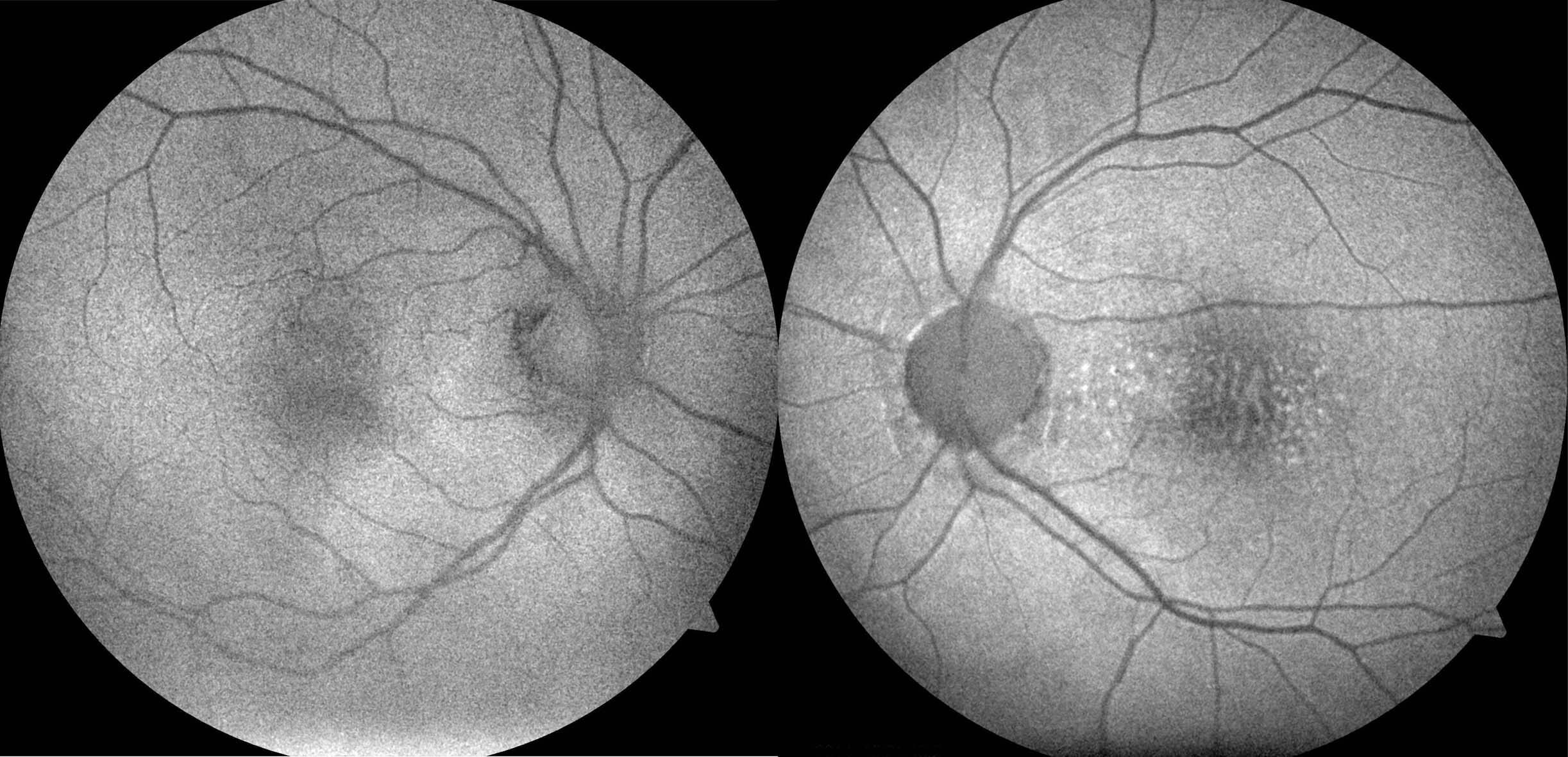 Fundus autofluorescence highlights the macular deposits in the left eye.