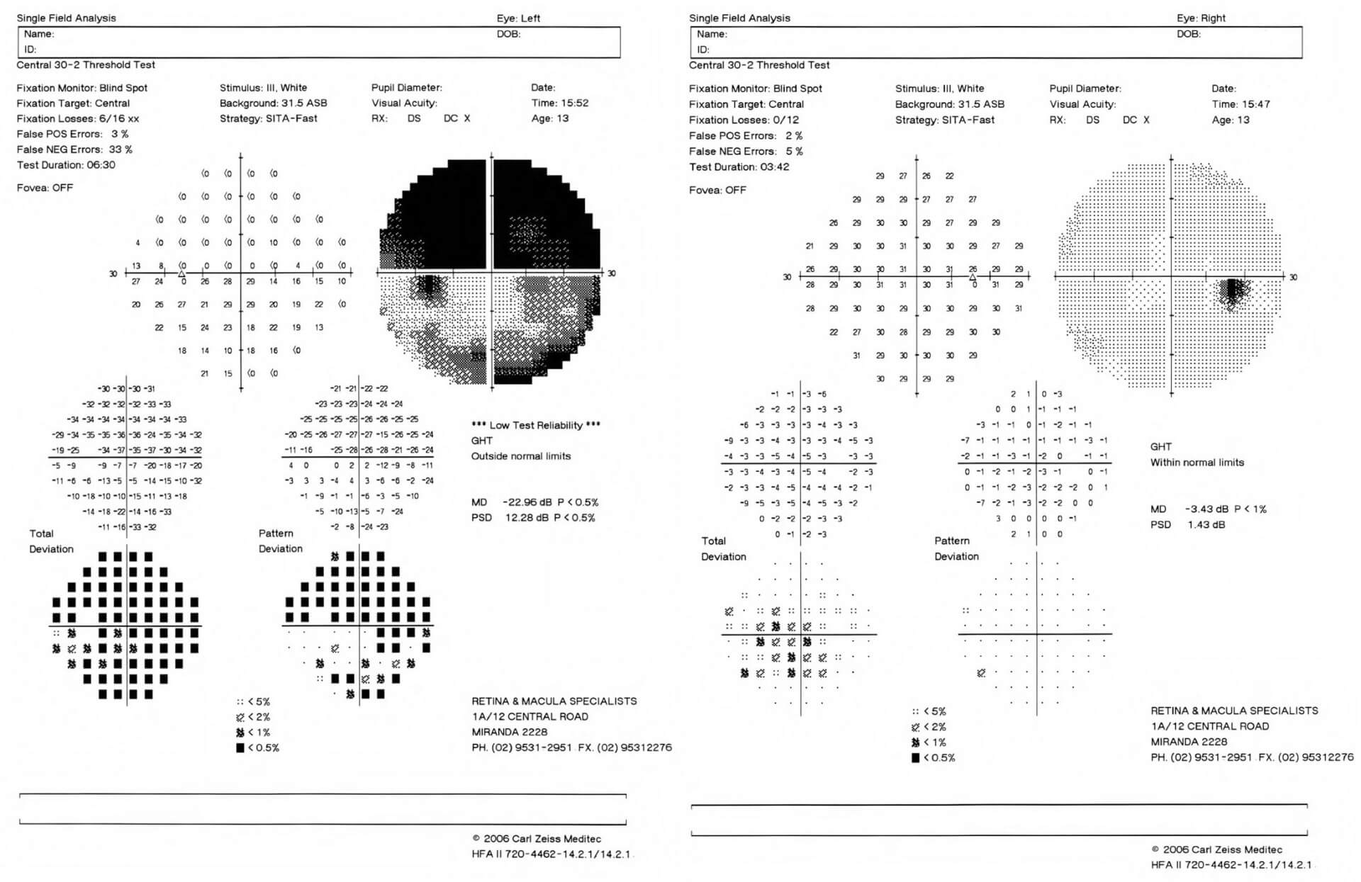 Humphrey visual field testing shows a dense left superior scotoma.