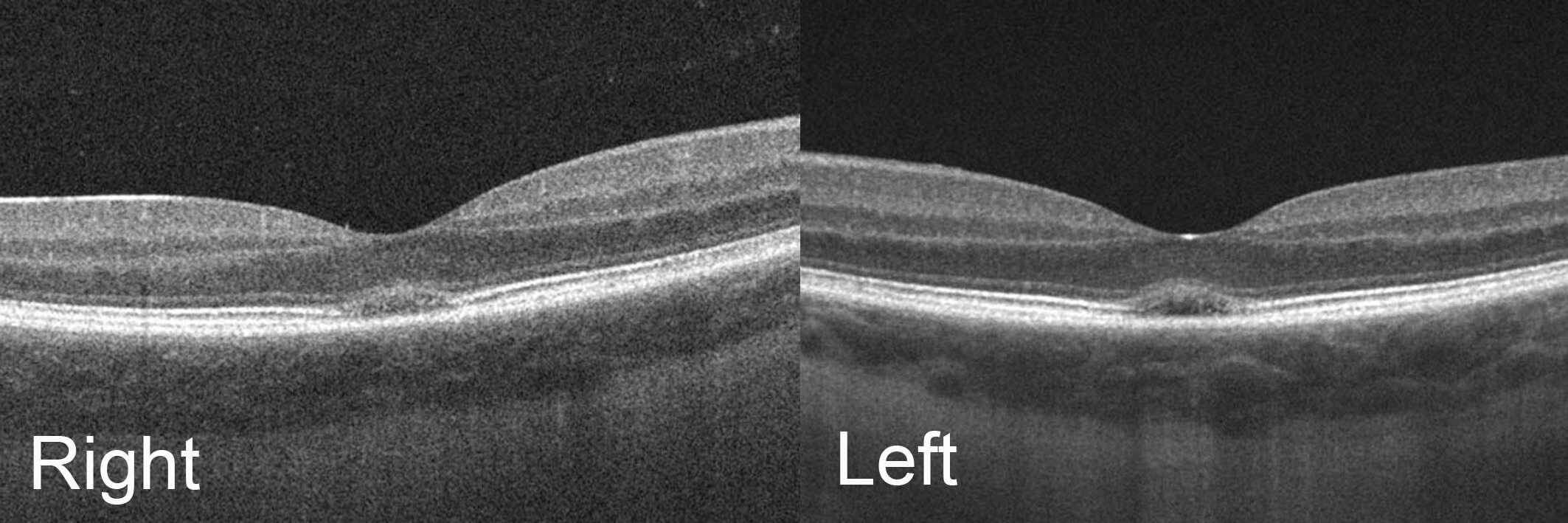 Optical coherence tomography images demonstrates dome shaped retinal elevations and subfoveal ellipsoid layer (inner segment/outer segment) loss.